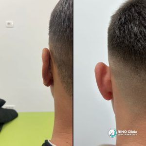 Ohrkorrektur Vorher Nachher Ergebnis Fall 1